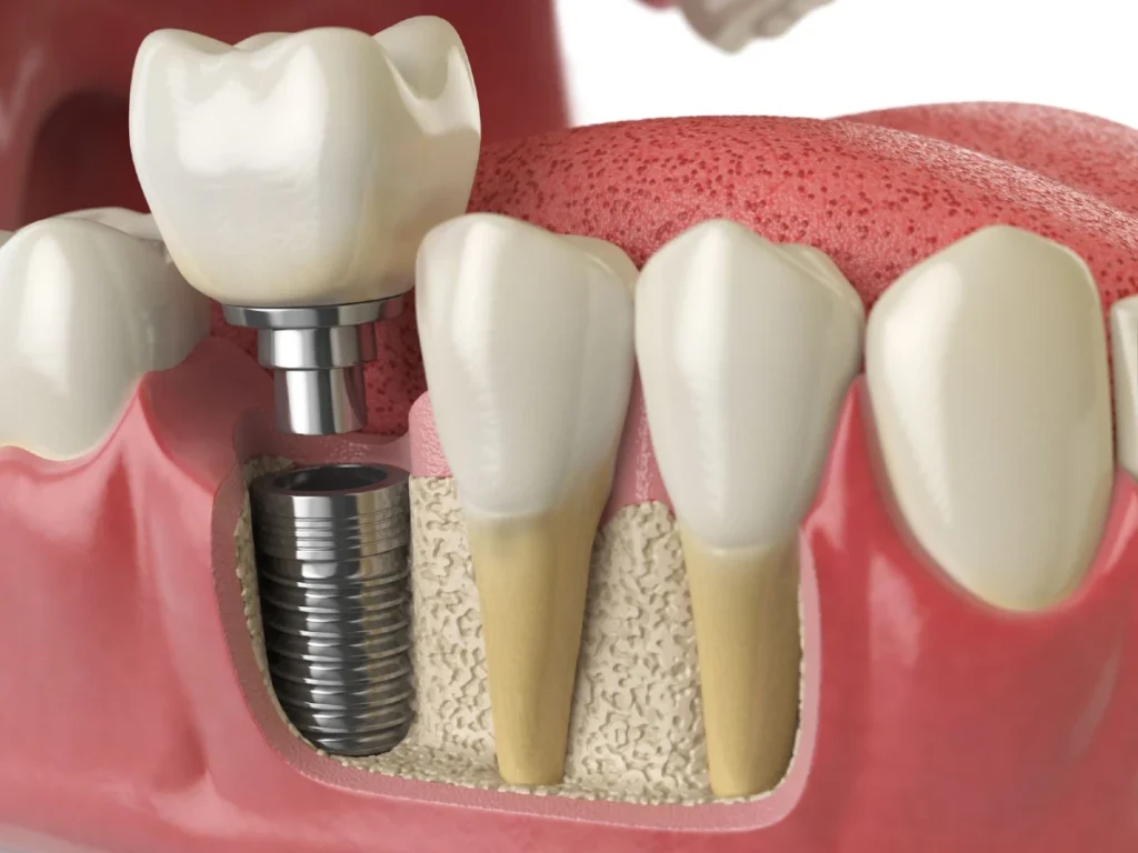 implant dentar