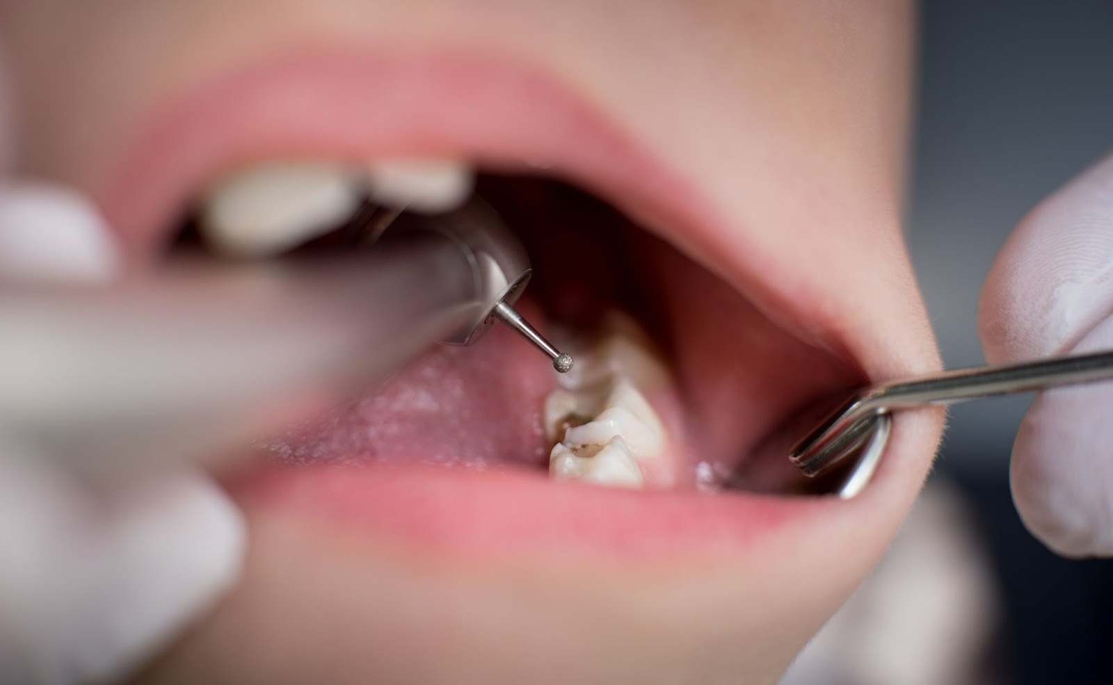 plombele dentare